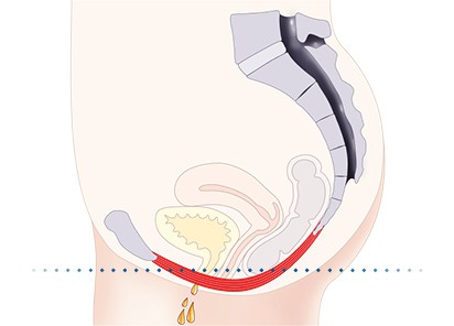 Pelvic-Floor Muscle Repair 5 Pelvic floor muscles Hayes