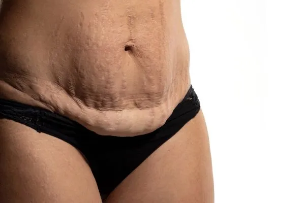 The Science of Skin Tightening 1 The science behind skin tightening Hayes picture of a woman's sagging skin on the stomach